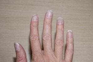 Ongles cassants 6 astuces pour y remédier