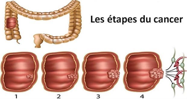 soigner le most cancers par le froid