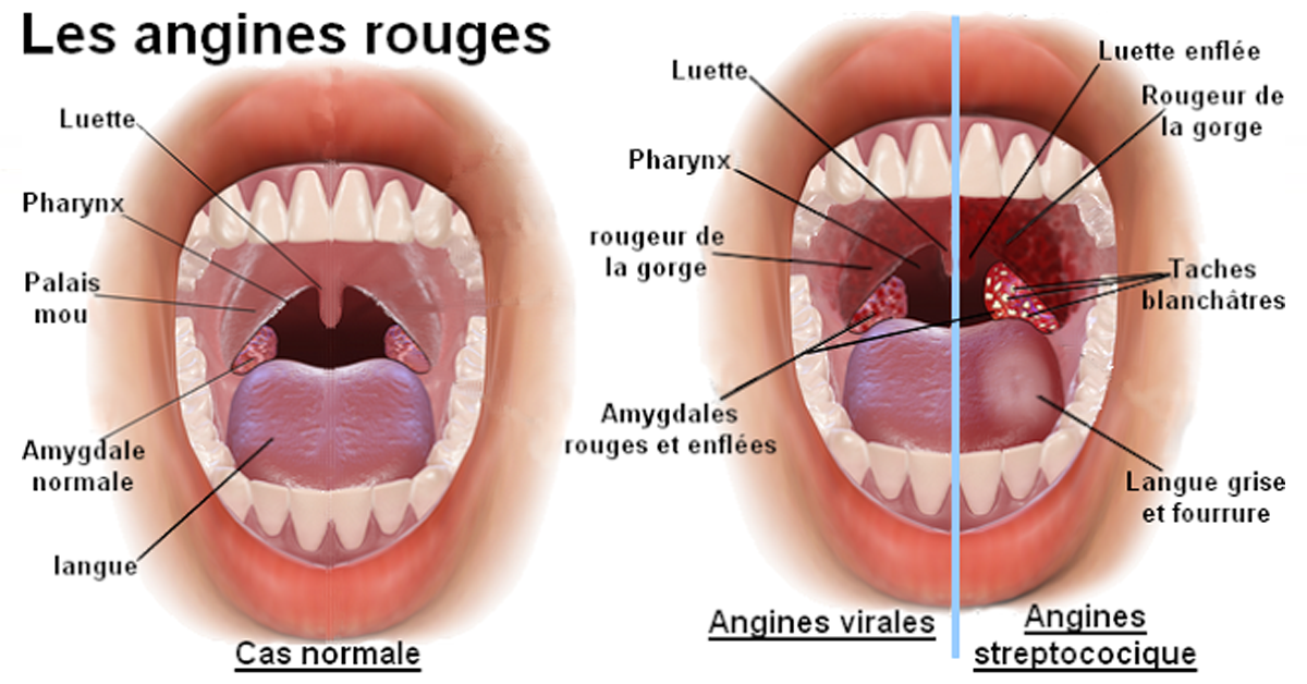 Angine remedes naturels