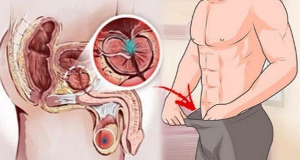 12 alarming signs of prostate cancer that all men need to know! Do not ignore them!