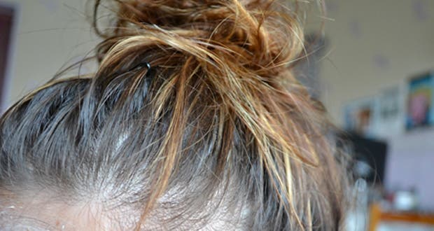 3 hair problems that indicate health problems