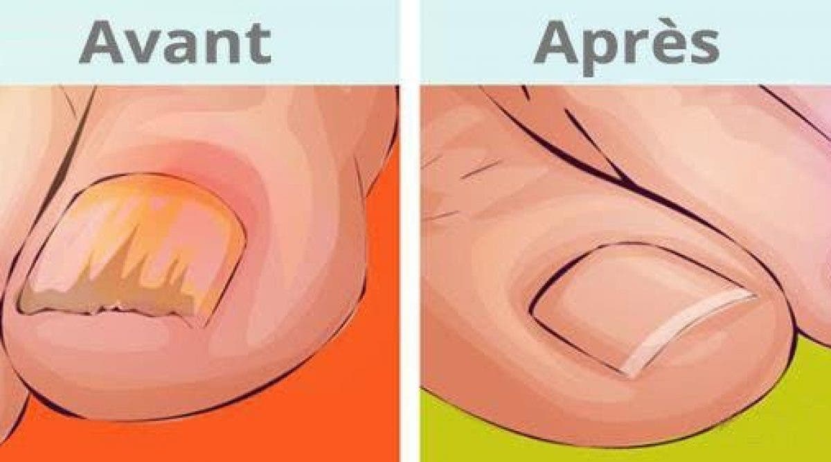 4 Remèdes Simples Et Efficaces Pour Traiter Les Champignons