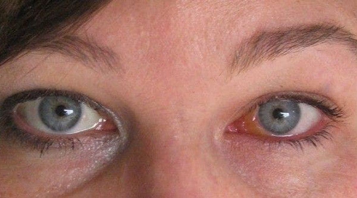 5 Remèdes Maison Pour Dégonfler Les Yeux