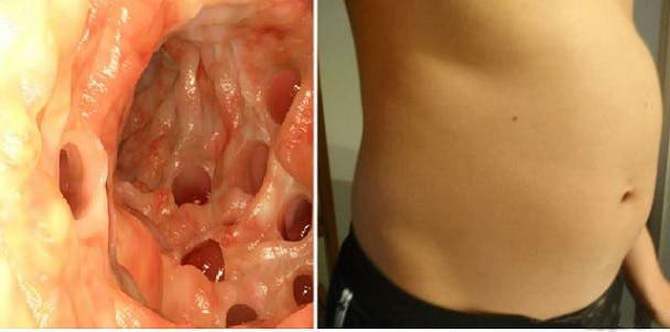 50% of colon cancer cases can be avoided by doing this