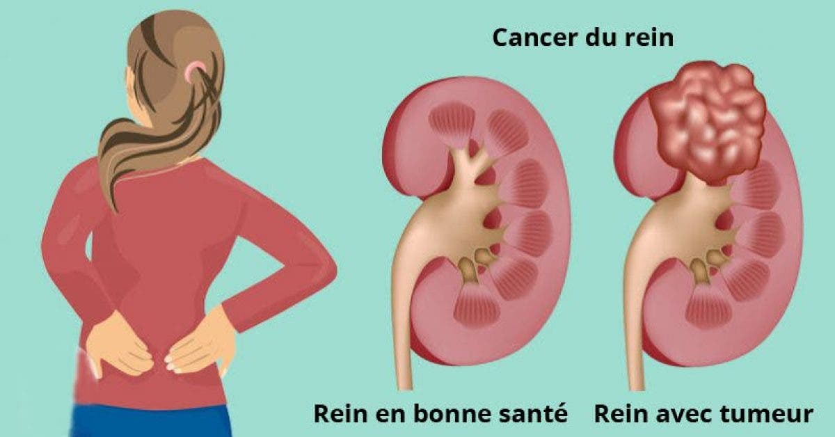 quels sont les symptômes du cancer du rein 