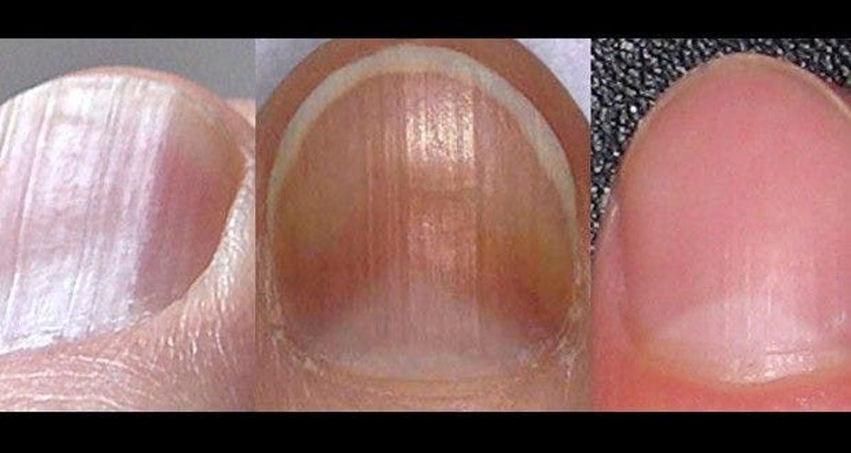 8 Problemes De Sante Detectable Sur Vos Ongles