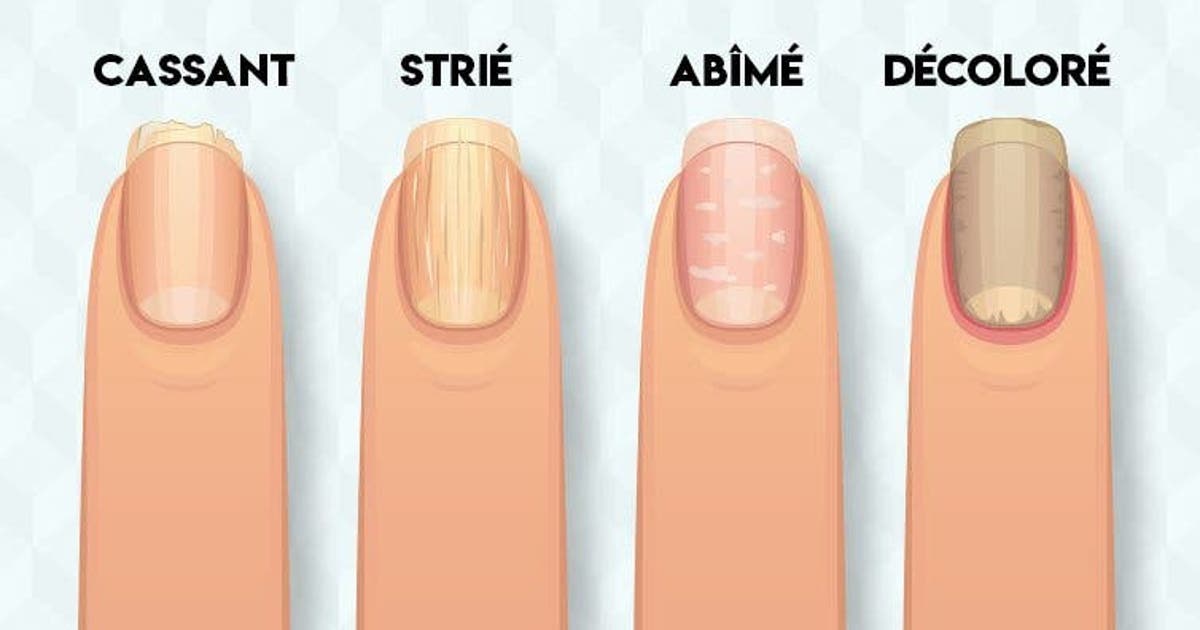 8 Problemes De Sante Que Revelent Vos Ongles