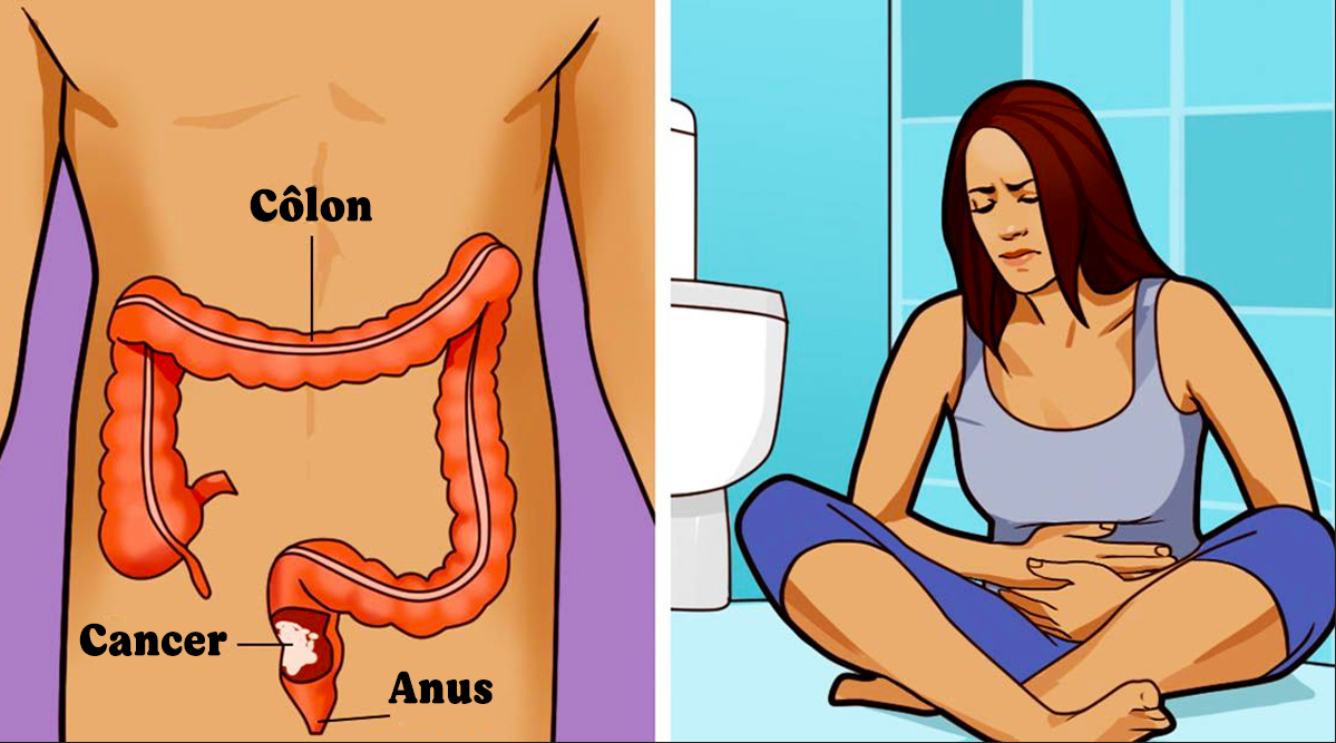 9 symptômes du cancer du colon