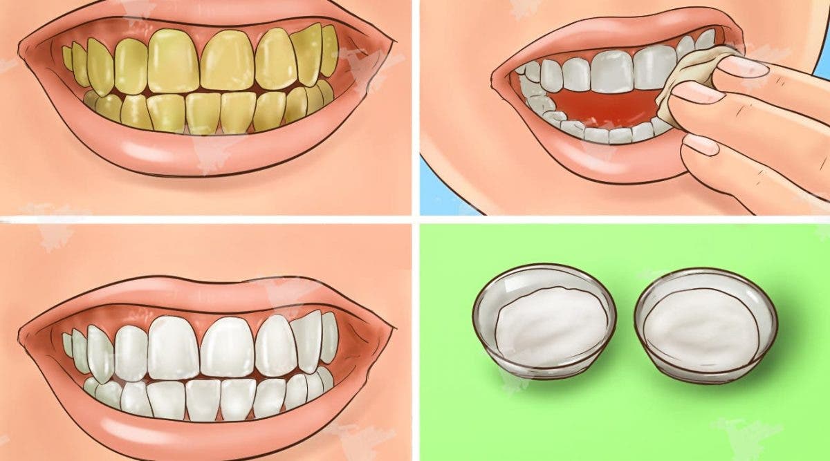 Voici Comment Eclaircir Des Dents Jaunes