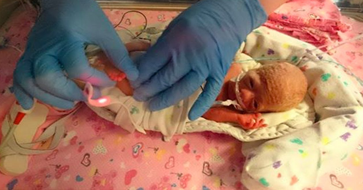 Ce Bebe Premature De 500 Grammes Est Fragile Et Mourant Le Medecin Lui Sauve La Vie Avec Un Sachet En Plastique De Supermarche