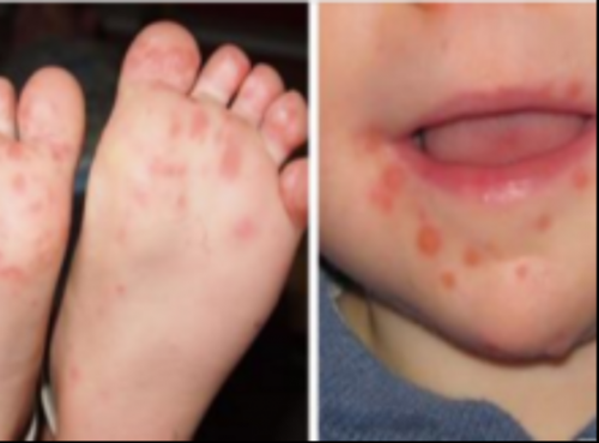 La Maladie Pieds Mains Bouche Revient Et Les Parents Devraient Faire Attention A Ces Symptomes