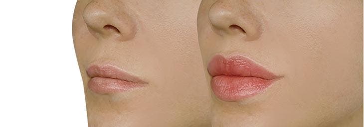 Corriger des lèvres fines. avant et après