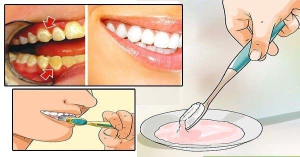 Get rid of plaque in only 5 minutes! This will change your life!