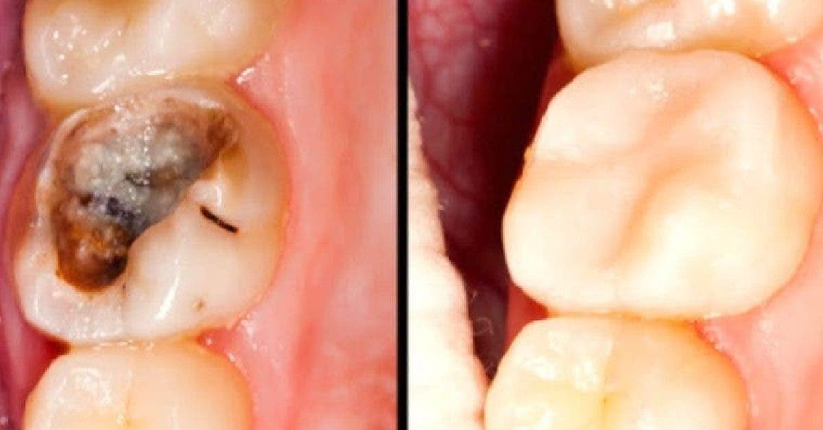 Des Scientifiques Ont Decouvert Un Medicament Qui Fait Repousser Les Dents Cassees