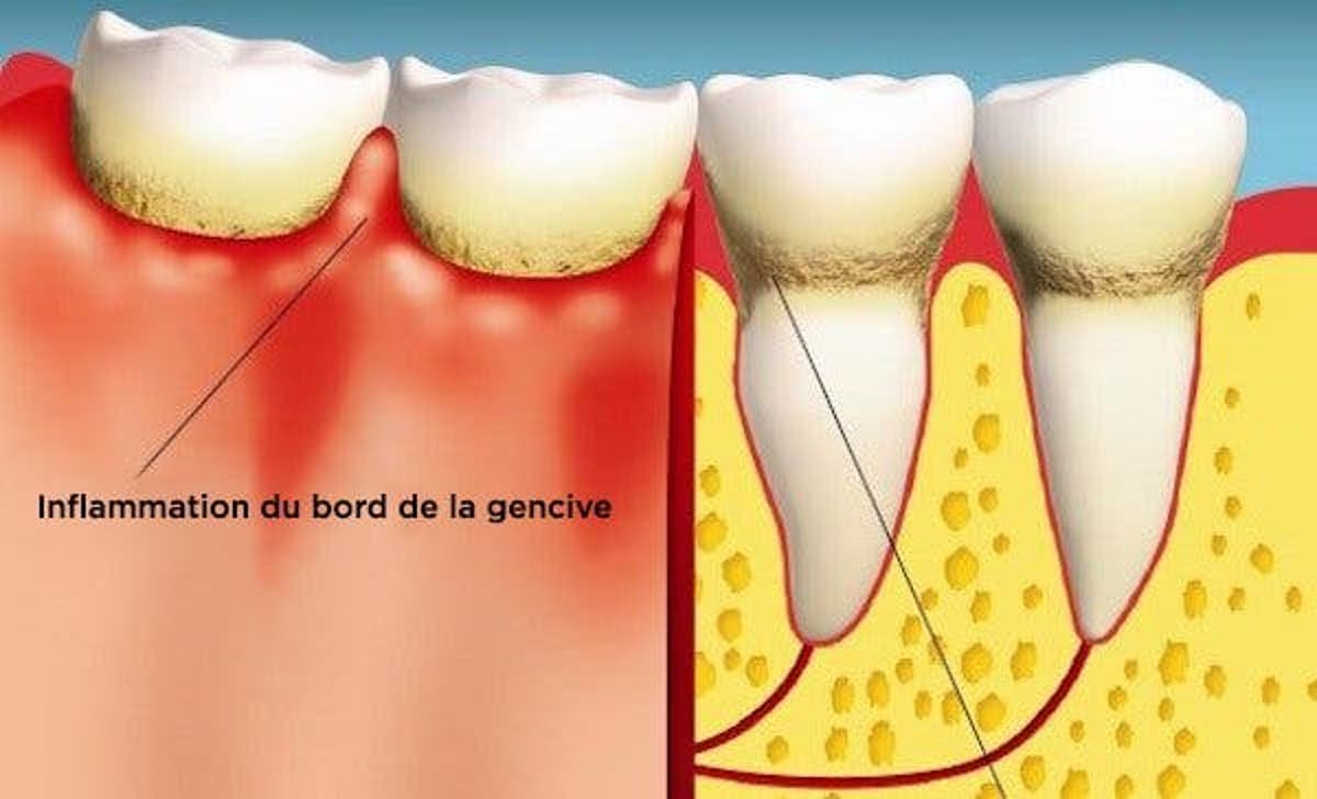 Les Maladies Des Gencives Sont Des Tueurs Silencieux Voici Comment Vous Pouvez Les Guerir Les Maladies Des Gencives Sont Des Tueurs Silencieux Voici Comment Vous Pouvez Les Guerir Les Maladies