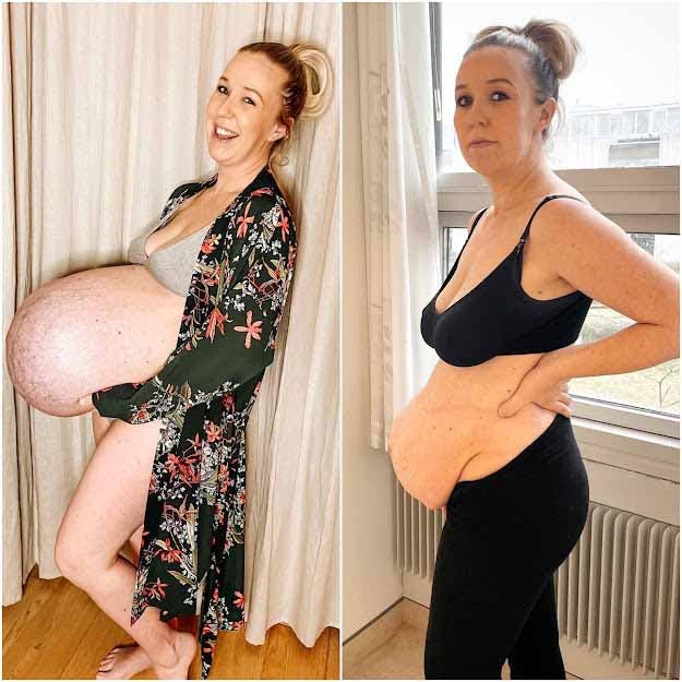 Le ventre de Michella avant et après l’accouchement