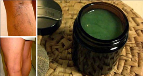 A powerful remedy to fight varicose veins. You will be surprised at the results!