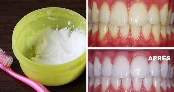 Here's how to have white teeth naturally and quickly