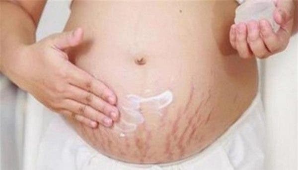 Here's how to erase your stretch marks