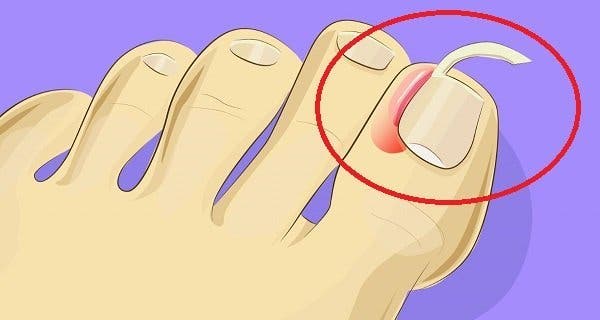 Here's how to cure an ingrown toenail without the need for surgery!