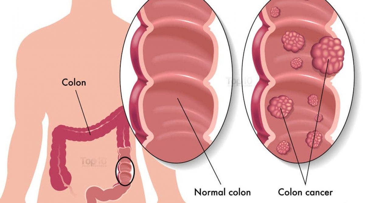 Voici les symptômes du cancer de l'estomac à détecter