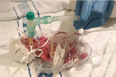 Ce Bebe Premature De 500 Grammes Est Fragile Et Mourant Le Medecin Lui Sauve La Vie Avec Un Sachet En Plastique De Supermarche