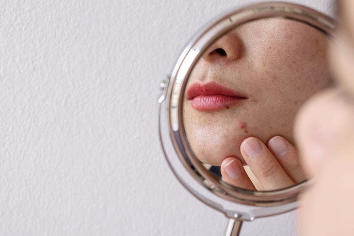 Causes profondes de l'acné 