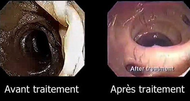 What happens when you clean your colon