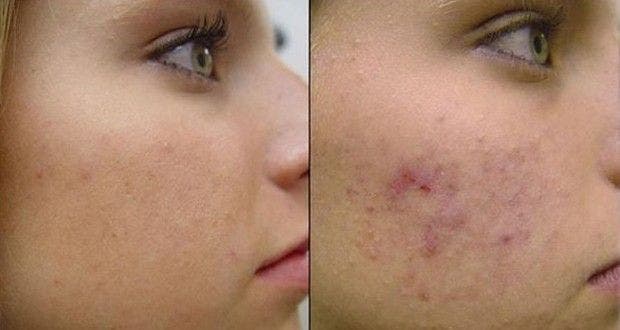 This incredible plant eliminates acne and pimples