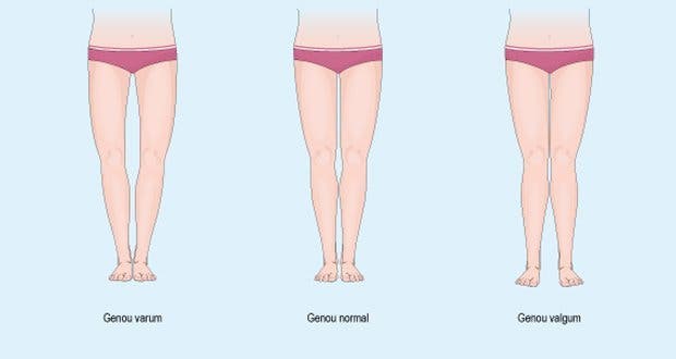 Voici Comment Corriger Et Prevenir Les Jambes Arquees