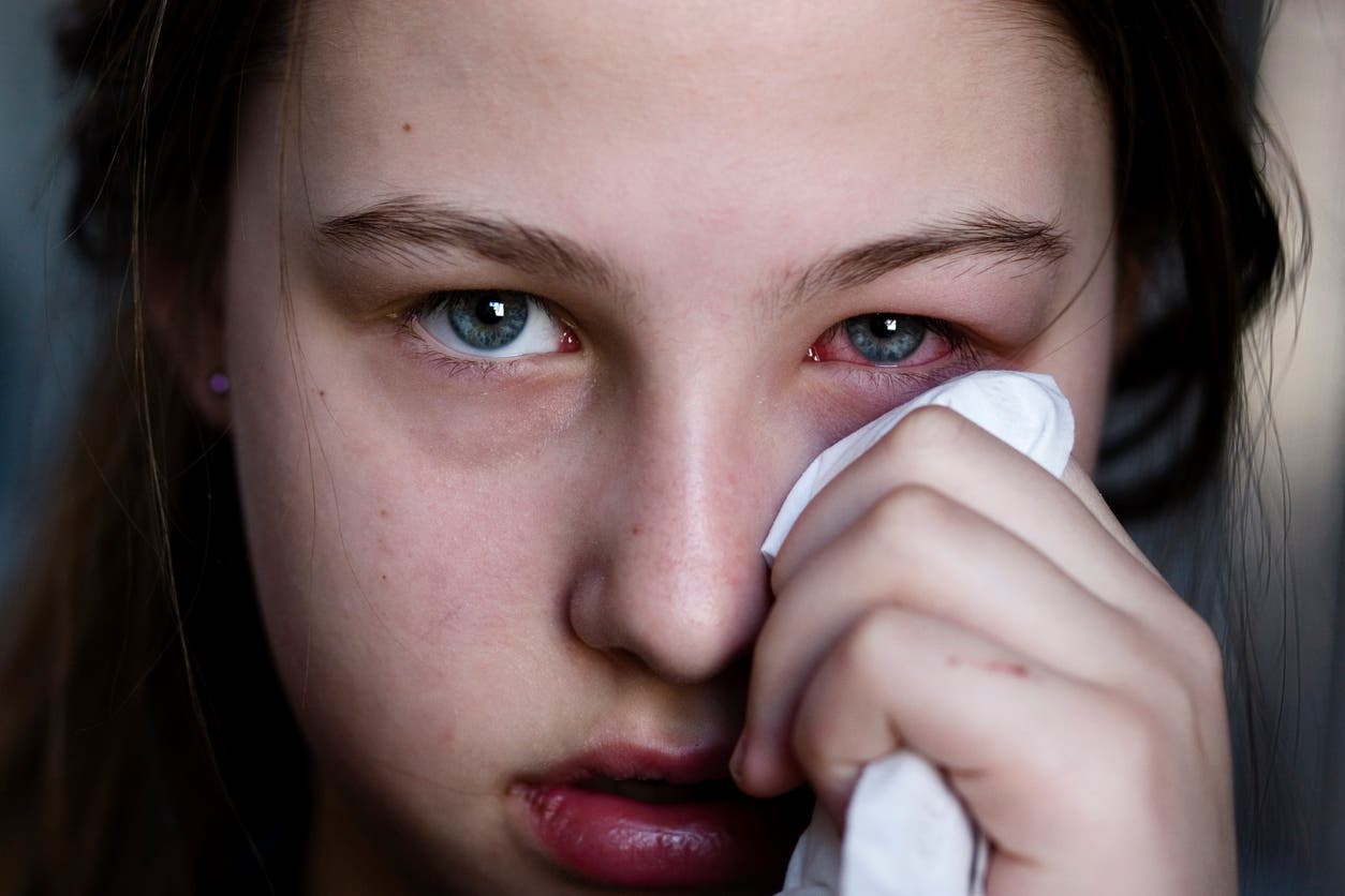 Yeux rouges : un symptôme du Covid à surveiller