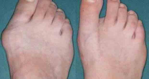 Get rid of this bone deformity in 10 days