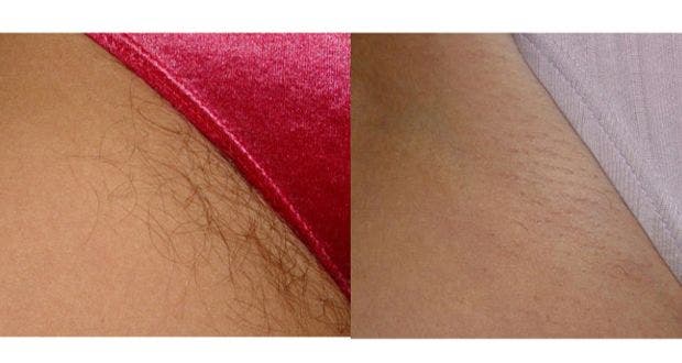 Get rid of unwanted hair forever!