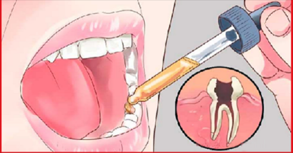 Tip: say goodbye to dental pain in 5 seconds thanks to this powerful remedy!