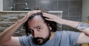 Greffe de cheveux : une solution efficace contre la calvitie ?