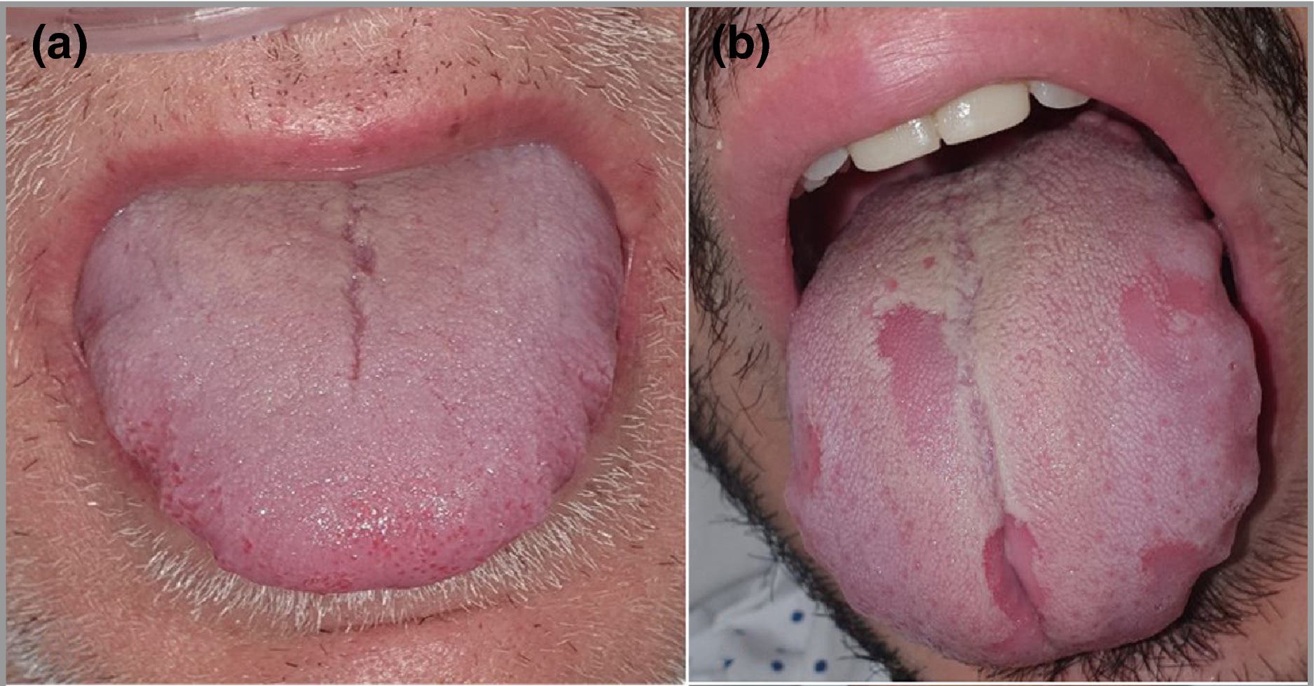 La « langue Covid » symptôme du coronavirus ?