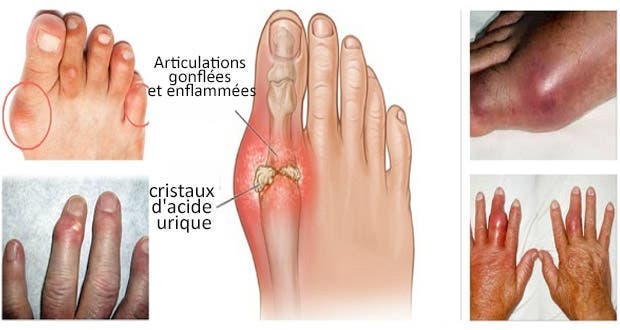 The best natural remedies for treating gout without surgery