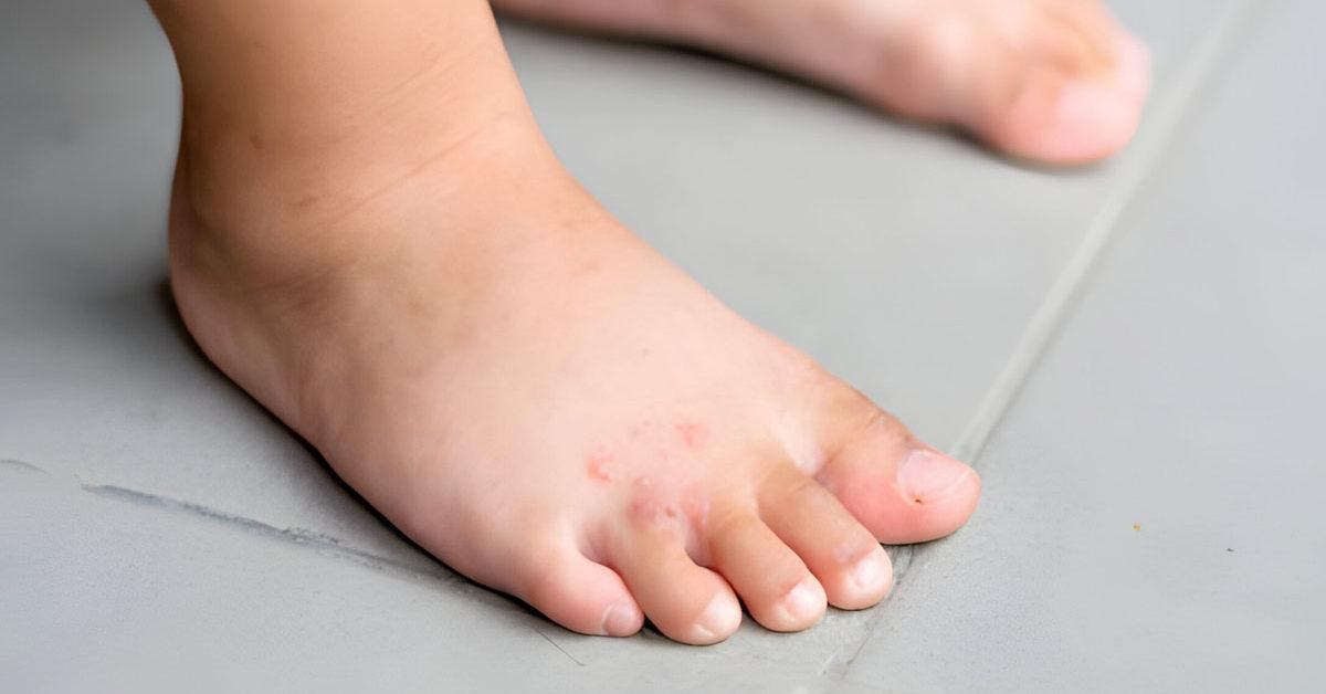 Mycose des pieds chez les enfants : symptômes & traitements ?