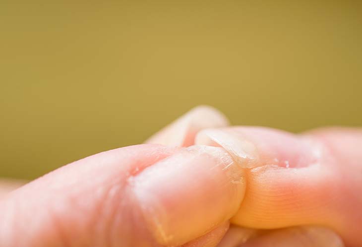 Lutter contre les ongles fragiles - source : spm