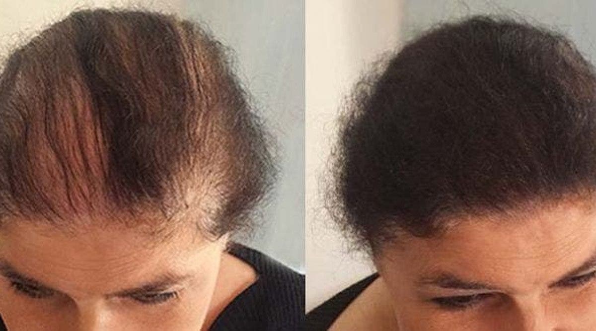 Utilisez du Brahmi pour faire repousser vos cheveux