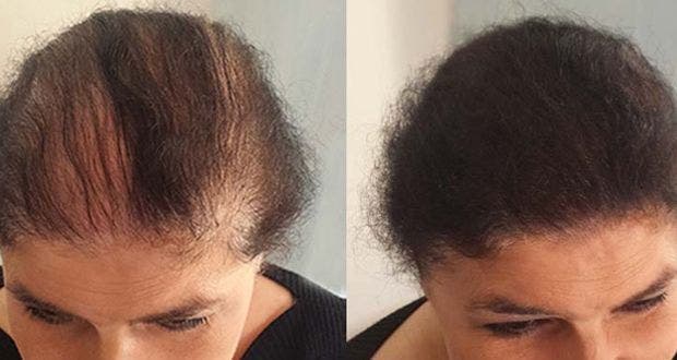 For a quick hair growth, try the secret of Indian women