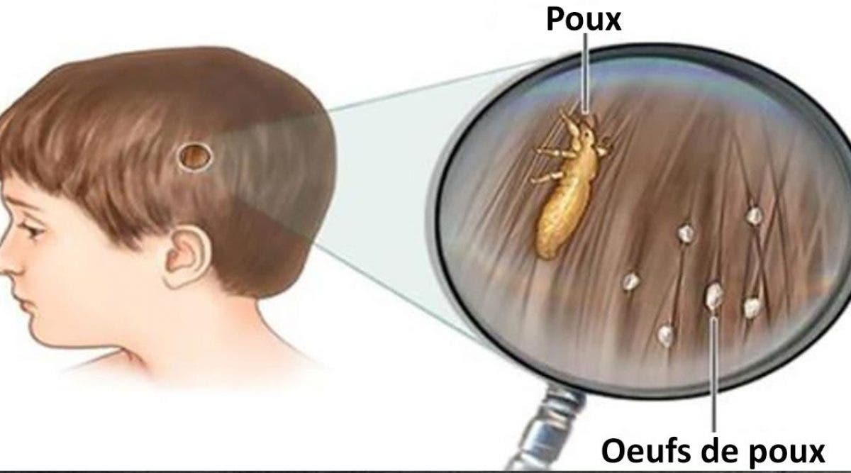 L Astuce Preferee Des Grands Meres Pour Se Debarrasser Des Poux Facilement Et Pour Pas Cher