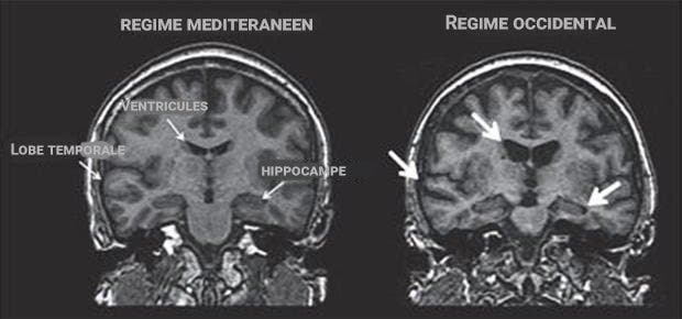 Nous Sommes Ce Que Nous Mangeons Voici Comment La Nutrition Affecte La Sante Du Cerveau