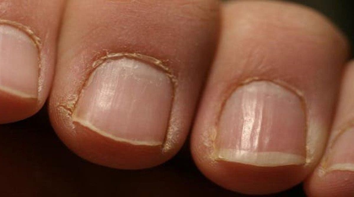 Voici Pourquoi Vous Avez Des Taches Blanches Sur Les Ongles