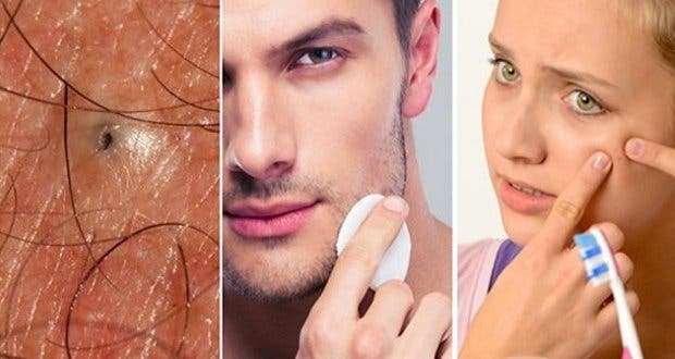 A powerful natural recipe for getting rid of blackheads