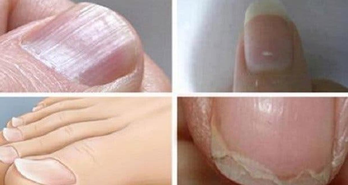 Voici Ce Que Représentent Les Lignes Blanches Sur Vos Ongles