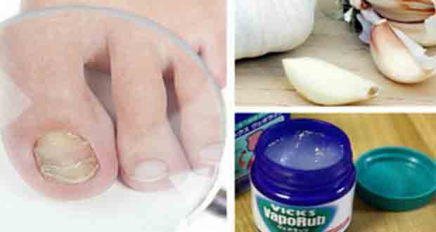 Here's how to eliminate nail fungus