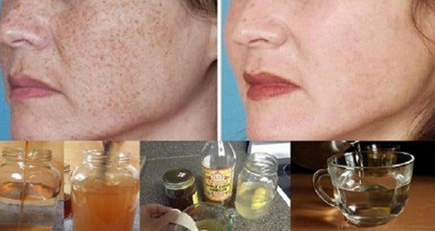 Here's how to reduce freckles, brown spots and scars