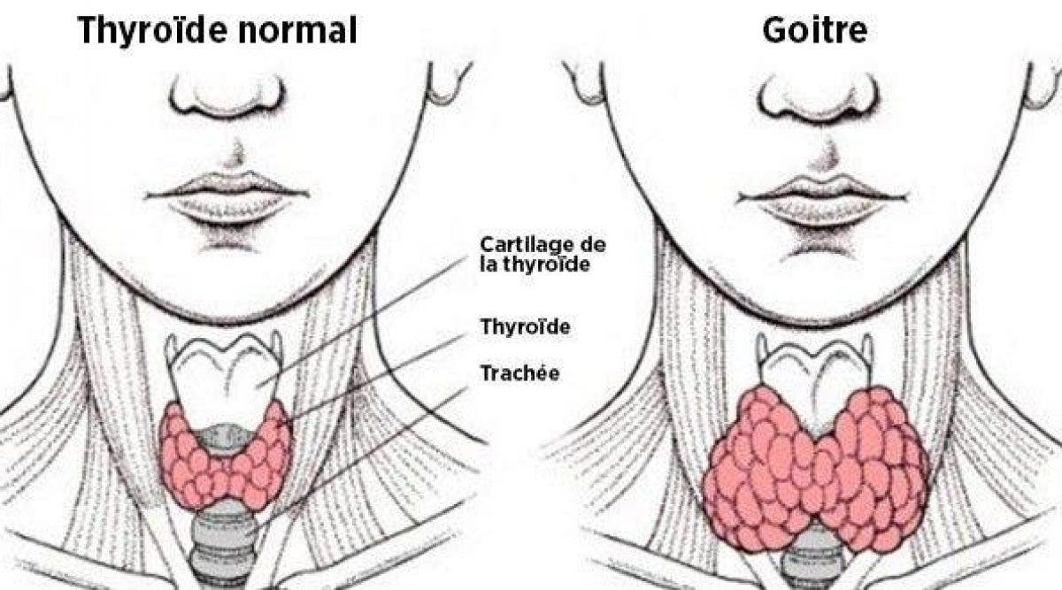 ménopause et transit intestinal - préménopause et troubles digestifs