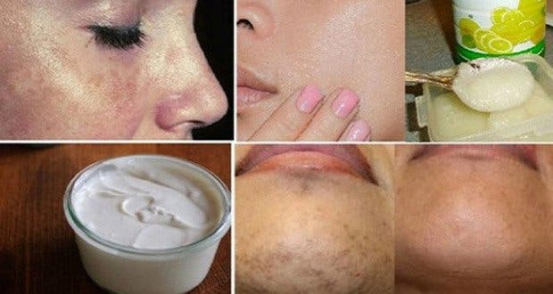 Here are the best natural home remedies to eliminate brown spots!